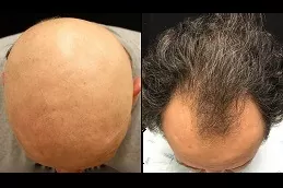 Alopecia Areata Treatment in Abu Dhabi