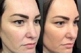 Aquagold Fine Touch Facial in Abu Dhabi