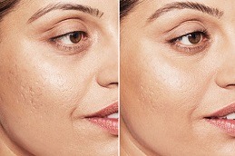 Aquagold Fine Touch Facial in Dubai & Abu Dhabi