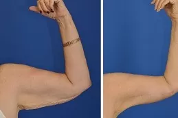 Arm Lift Surgery Clinic Dubai