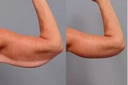 Arm Lift Surgery Clinic in Dubai