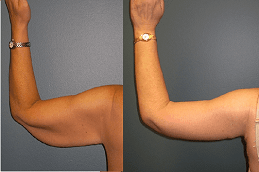 Arm Lift Surgery Dubai & Abu Dhabi