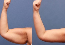 Arm Lift Surgery in Dubai & Abu Dhabi