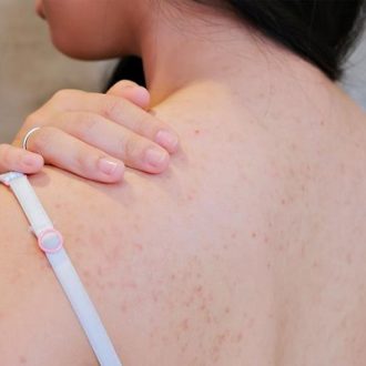 Back Acne Treatment Clinic in Dubai