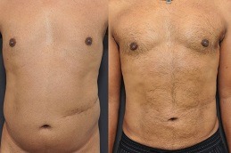 Best Affordable Liposuction in Dubai