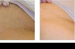 Best Clinic of Laser Hair Removal For Bikini Areas in Dubai