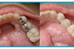 Best Clinic of Tooth Filling Cost in Dubai & Abu Dhabi