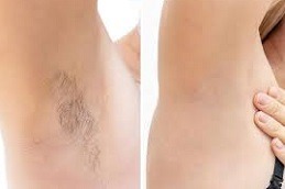 Best Clinic of Underarm Laser Hair Removal Dubai
