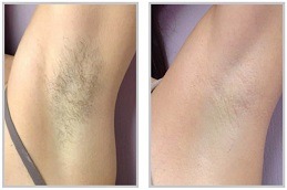 Best Clinic of Underarm Laser Hair Removalin Dubai