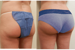 Best Hydrogel Buttock Injections Cost in Dubai