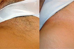 Best Laser Hair Removal For Bikini Areas Dubai