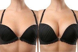 Best PRP Injections for Breast Lift in Dubai