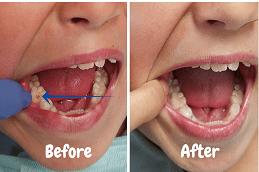 Best Tooth Filling Cost in Dubai & Abu Dhabi