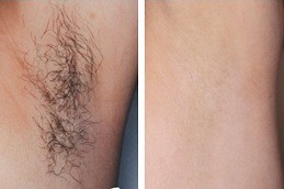 Best Underarm Laser Hair Removal in Dubai