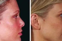 Bio Revitalization Treatment Abu Dhabi