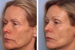 Bio Revitalization Treatment Clinic in Dubai