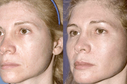 Bio Revitalization Treatment in Abu Dhabi