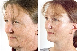 Bio Revitalization Treatment in Dubai
