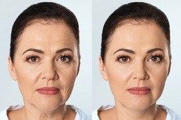 Bio Revitalization Treatment