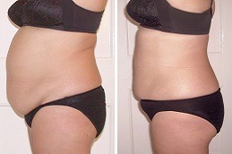 Body Jet Liposuction