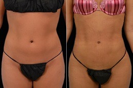 Best Body Jet Liposuction in Dubai