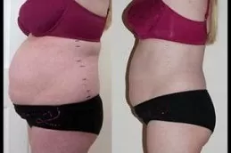 Best Body Jet Liposuction treatment
