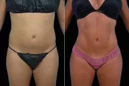 Body Jet Liposuction in Dubai
