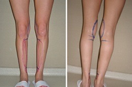 Calf Reduction in Dubai