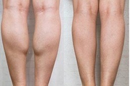 Calf Reduction in Dubai