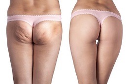 Cellulite Removal Dubai & Abu Dhabi