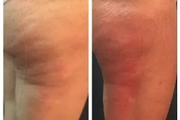 Cellulite Removal Treatment Clinic in Dubai & Abu Dhabi