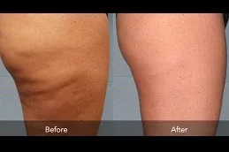 Cellulite Removal Treatment Clinic in Dubai