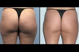 Cellulite Removal Treatment Dubai & Abu Dhabi