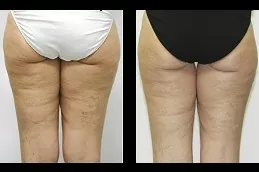 Cellulite Removal Treatment in Abu Dhabi