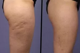 Cellulite Removal Treatment