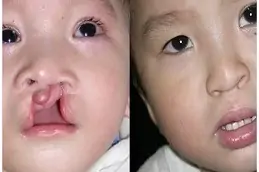 Cleft Lip and Palate Surgery Abu Dhabi