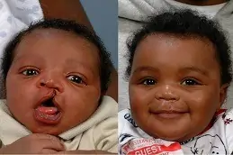 Cleft Lip and Palate Surgery