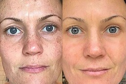 DMK Enzyme Therapy in Dubai