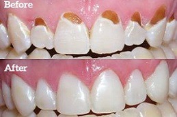 Tooth Filling in Dubai