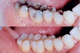 Tooth Filling Dubai
