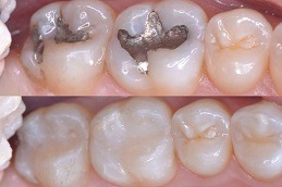 Dental Filling in Dubai