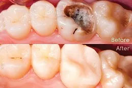 Dental Tooth Filling in Dubai