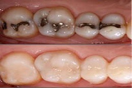 Dental Tooth Filling Dubai