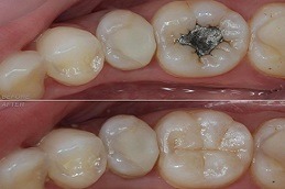 Dental Tooth Filling