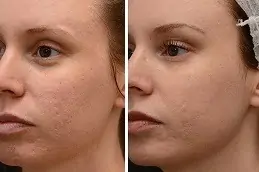 Dermapen Treatment Abu Dhabi