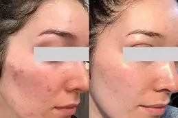 Dermapen Treatment Clinic in Dubai