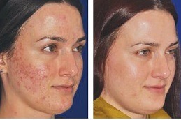 Dermapen Treatment in Dubai & Abu Dhabi
