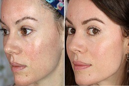 Dermapen Treatment in Dubai