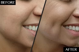 Dimple Creation Surgery Abu Dhabi