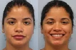 Dimple Creation Surgery Clinic in Abu Dhabi